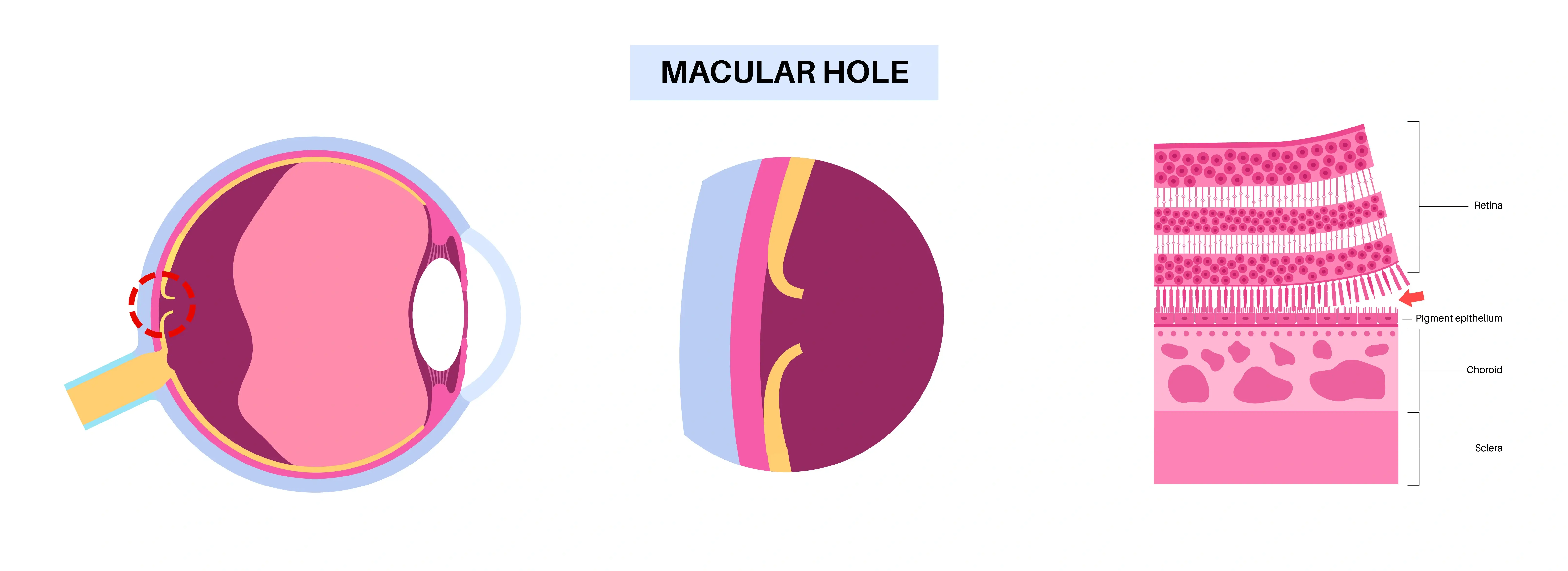 Macular Hole
