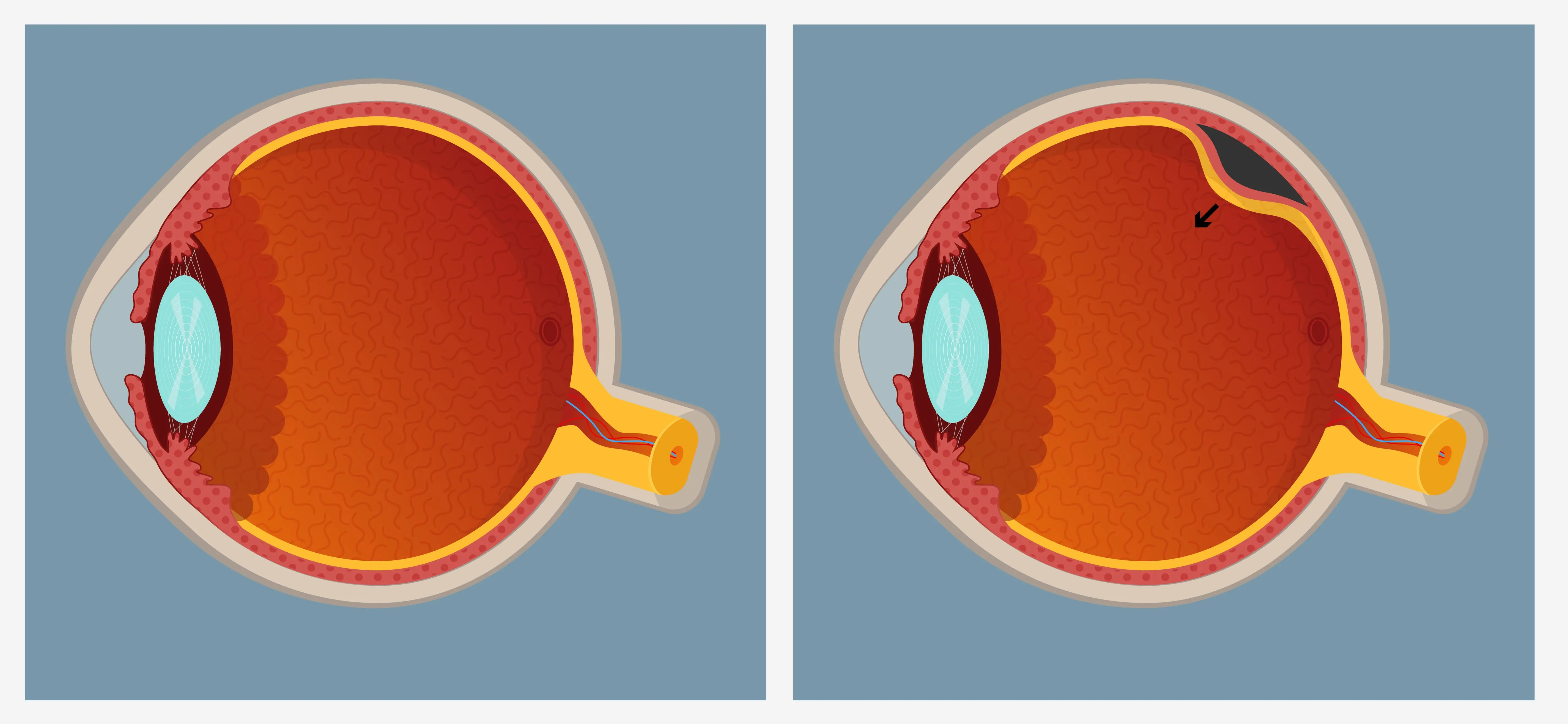 Retinal Detachment