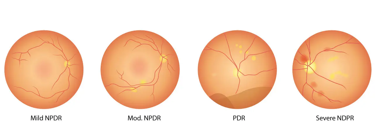 Diabetic Retinopathy