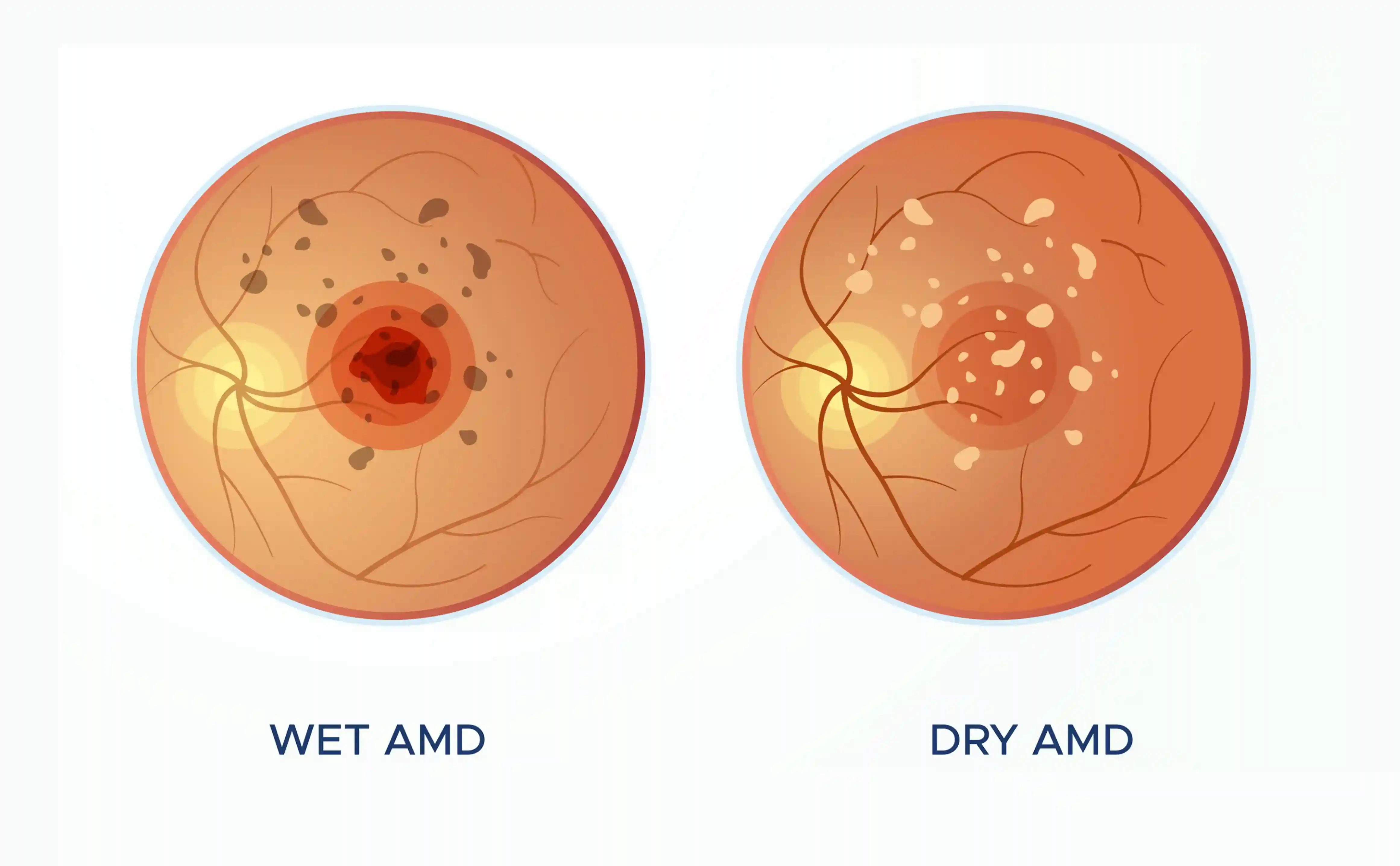 Dry vs Wet AMD Diagram