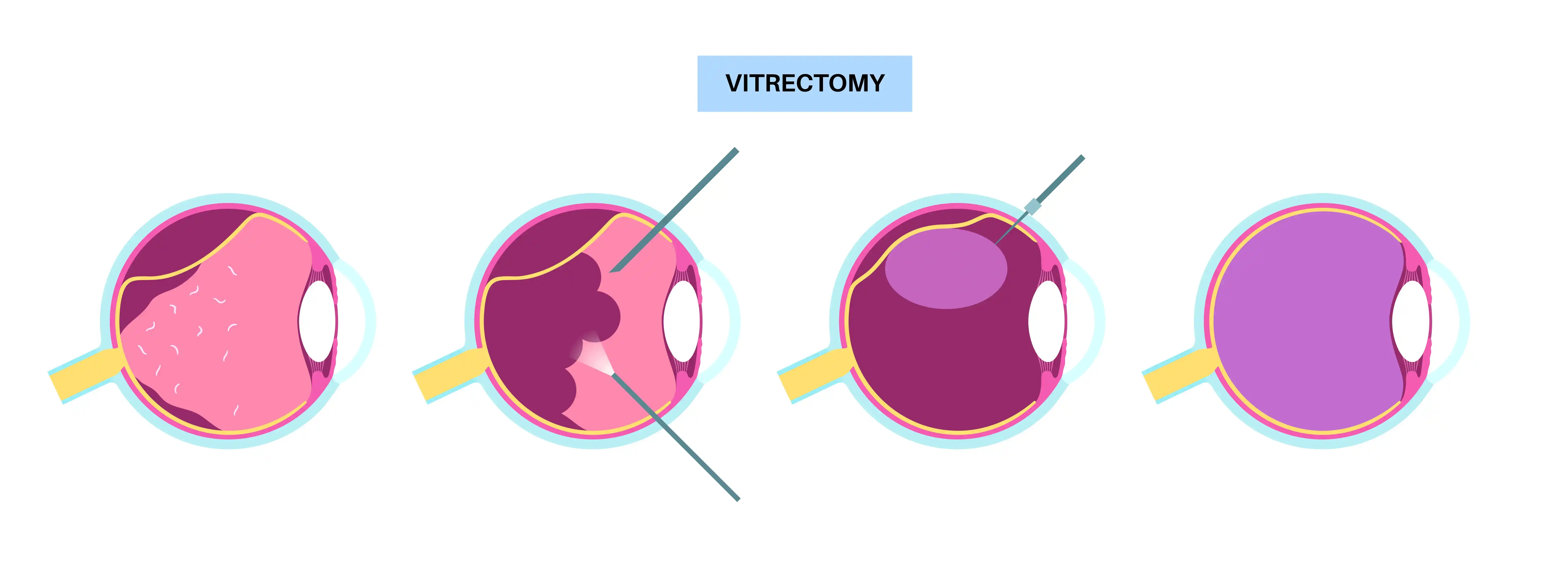 Vitrectomy