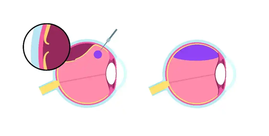 Pneumatic Retinopexy Procedure Diagram