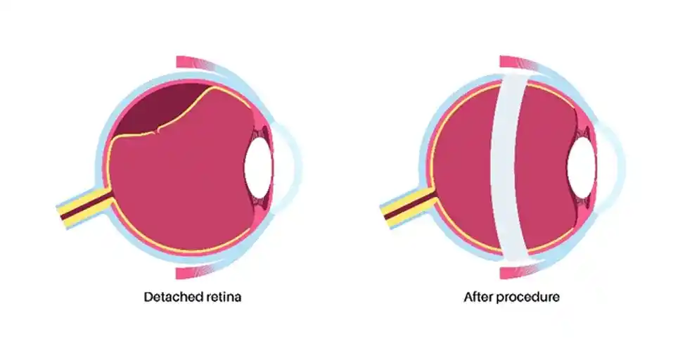 Pneumatic Retinopexy Recovery 
