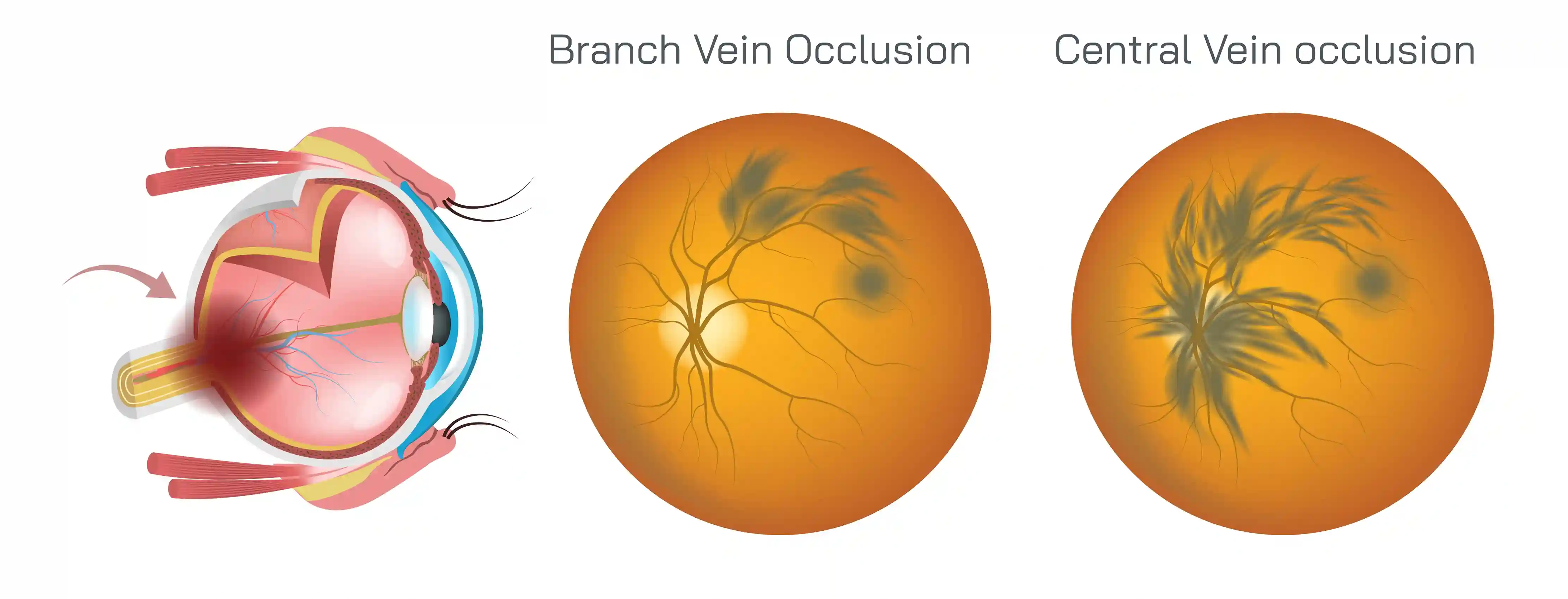 Retinal Vein Occlusion