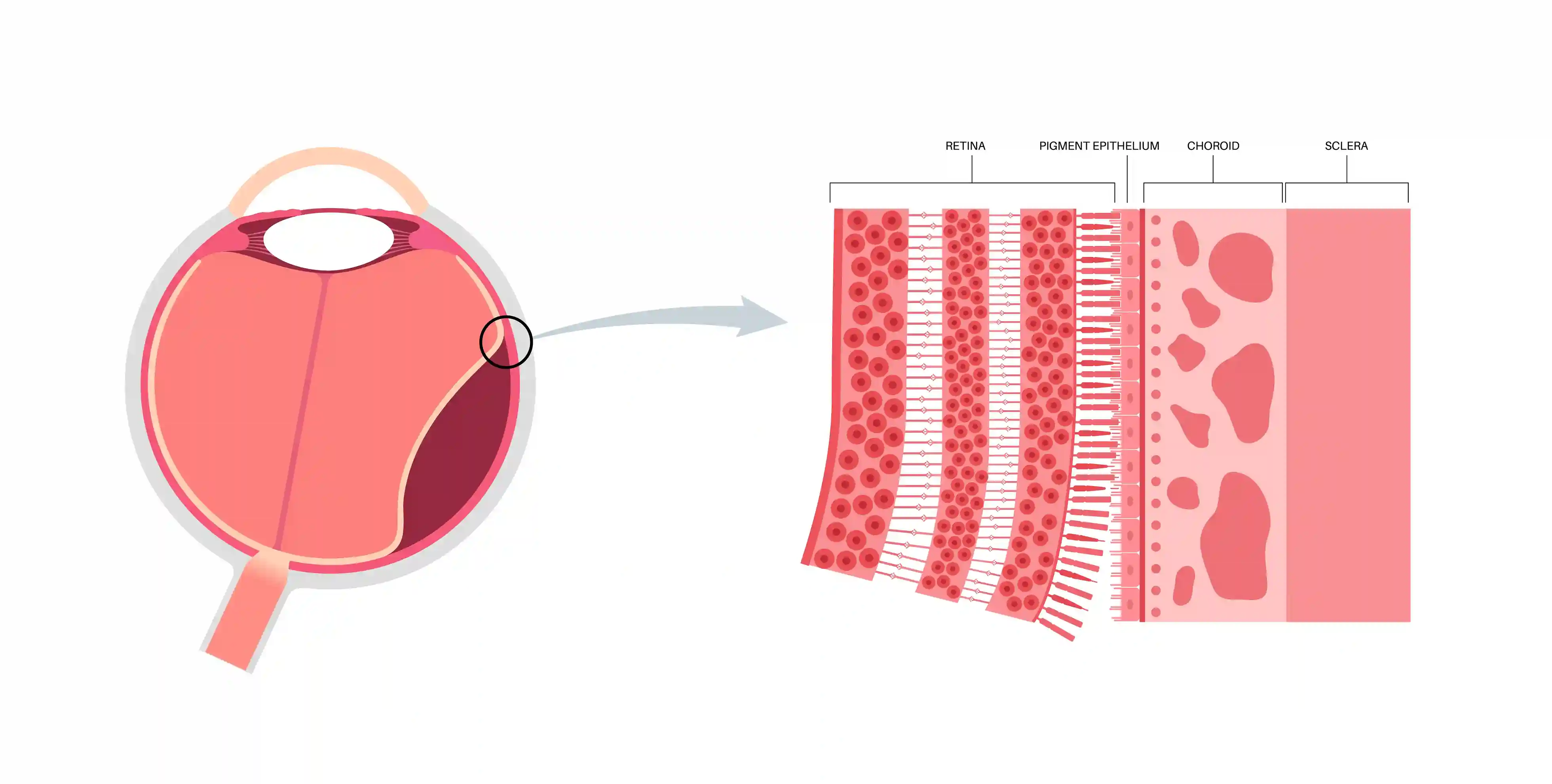 Retinal Thinning and Detachment