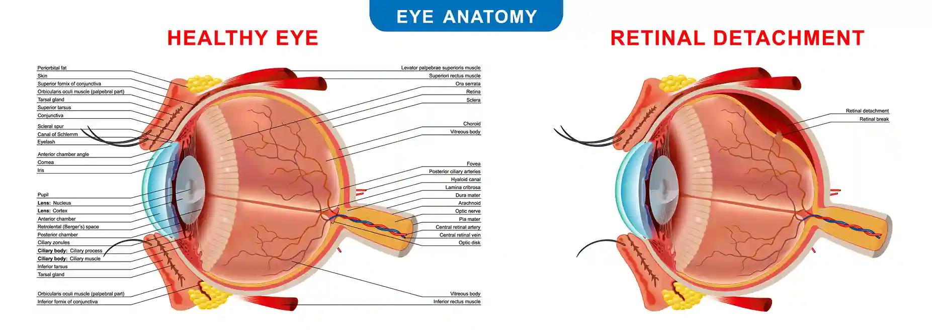 Retinal Tear Diagram